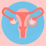 What Is Polyendocrine Metabolic Ovarian Syndrome (PMOS), Formerly Known as PCOS? Symptoms, Causes, Diagnosis, and Treatment